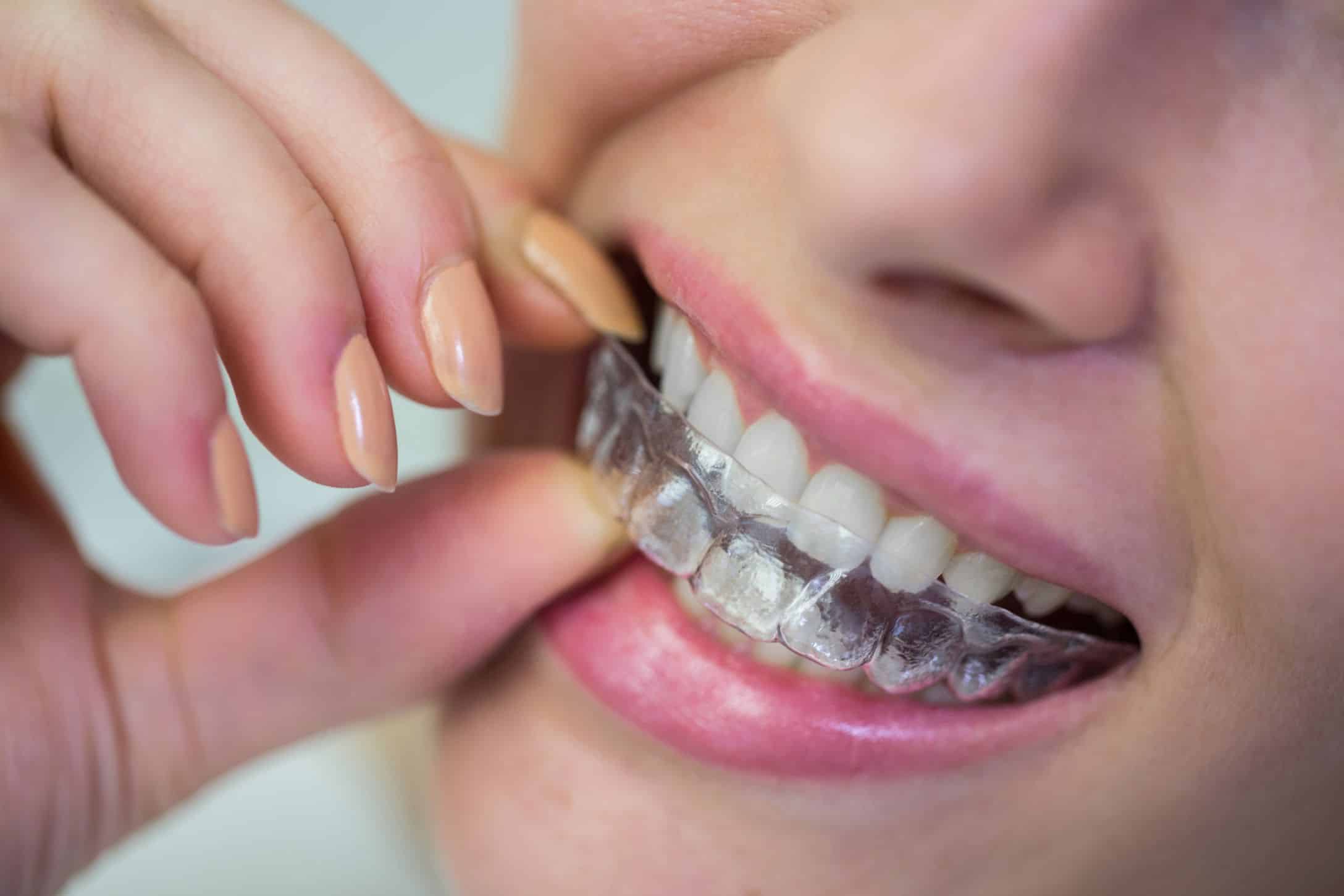 Benefits of Invisalign for Professional Adults